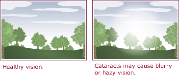 Cataract Glare